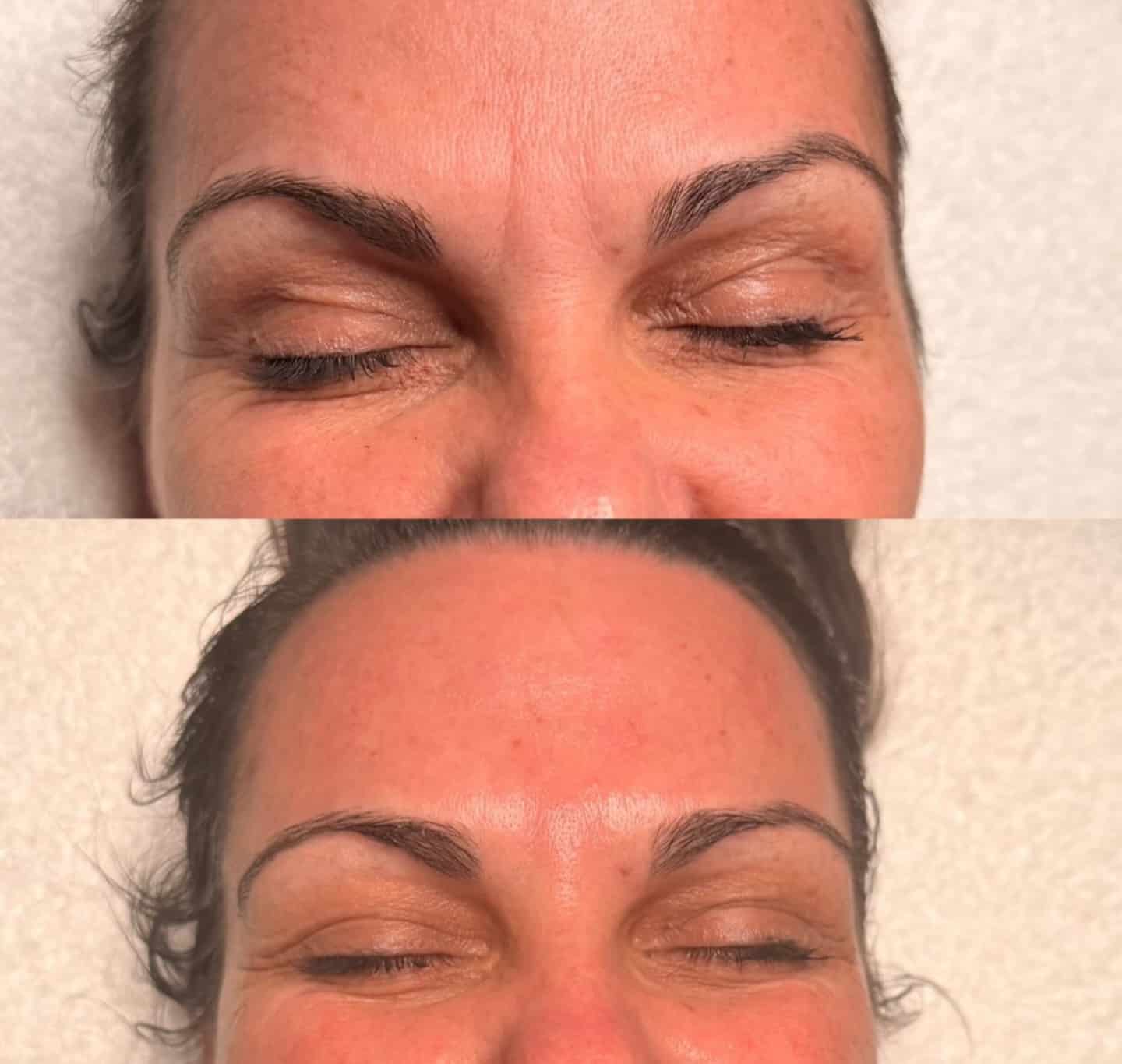 A close-up before-and-after view of a woman’s forehead and closed eyes, shown in two stacked images against a light background.