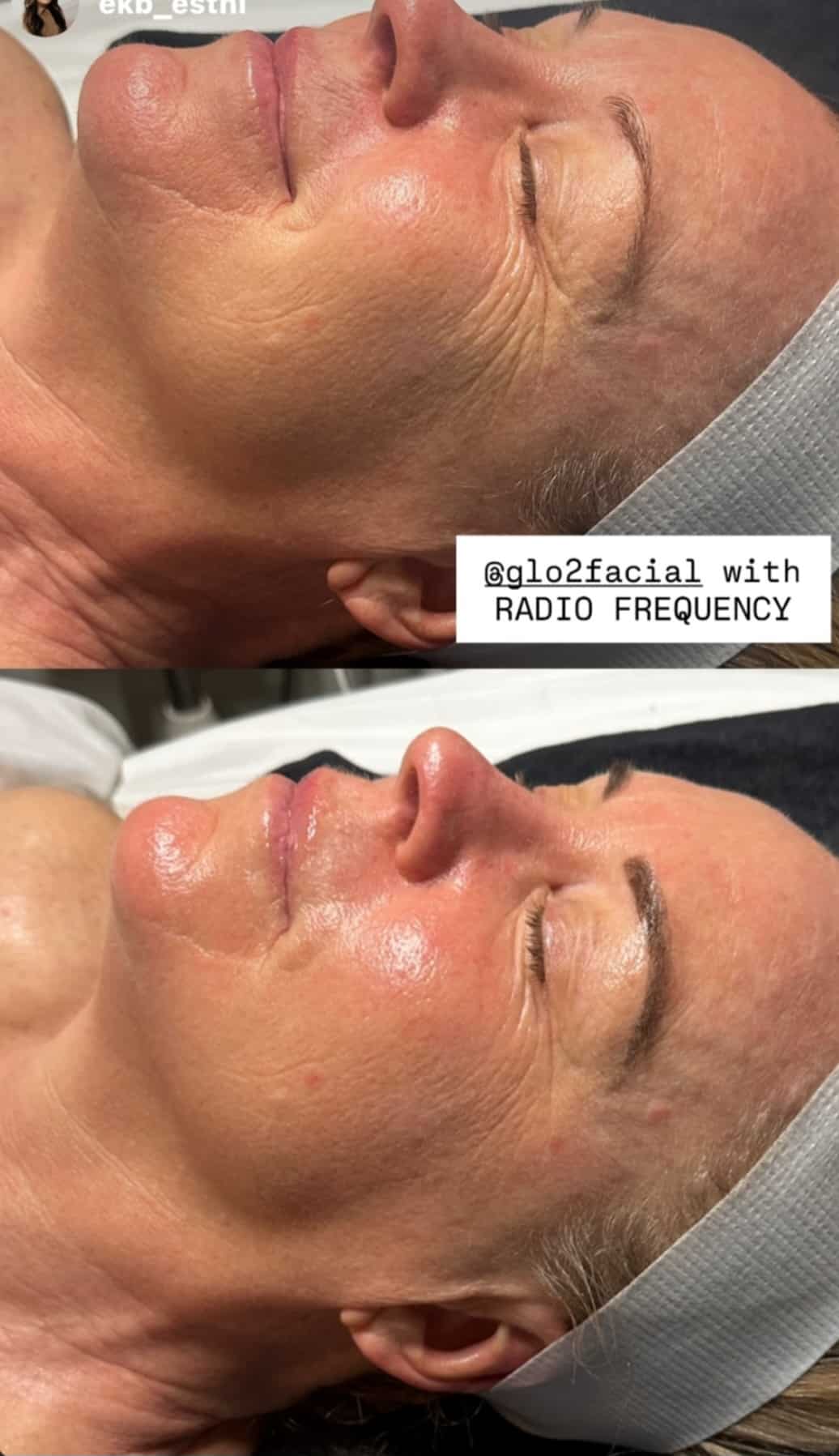Two side-by-side close-up photos show the same woman lying on a treatment bed with a gray headband, her face appearing smooth and glistening after a Glo2 facial with radio frequency.