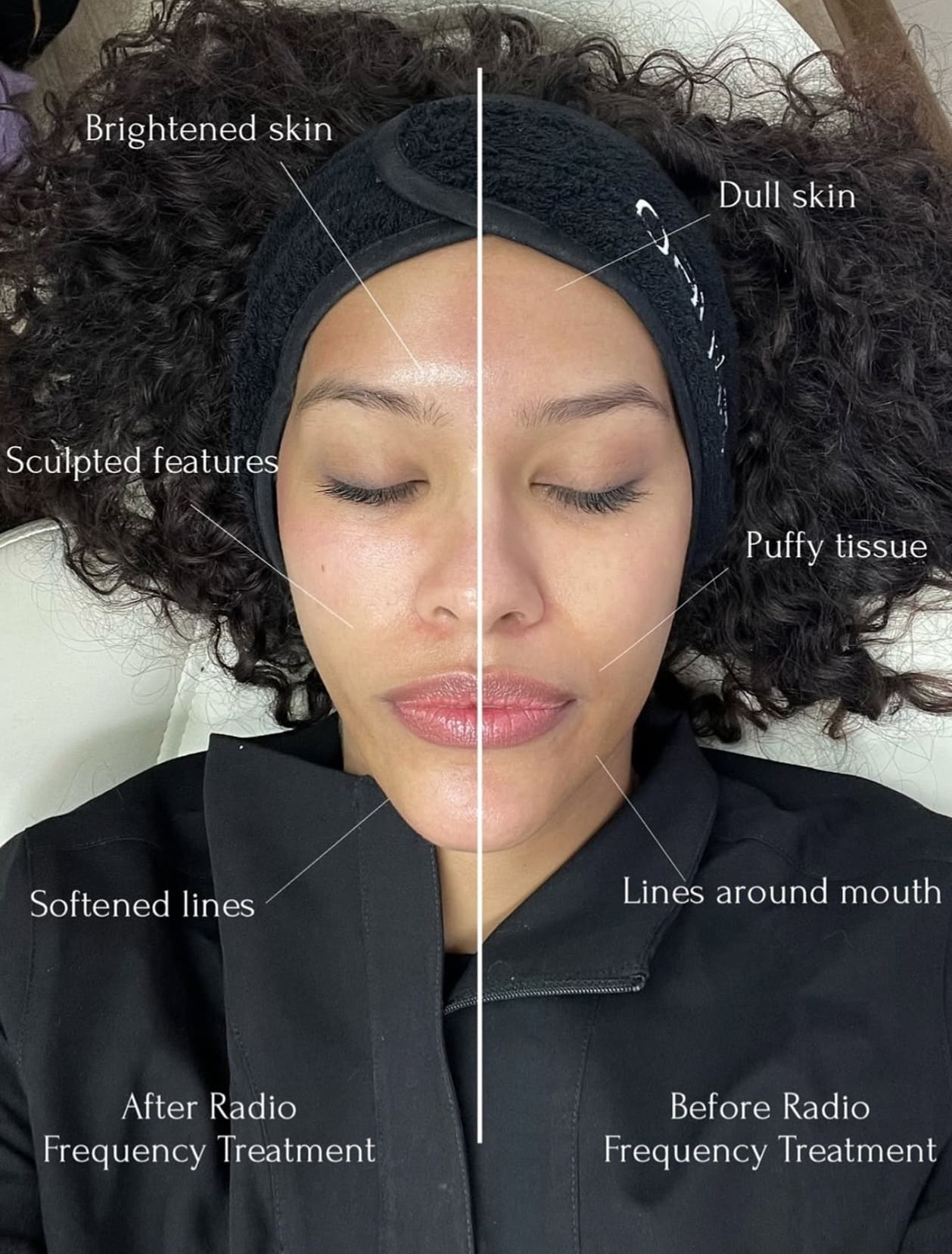 A split-face portrait of a woman lying down, labeled to compare after and before radio frequency treatment, with a headband and curly hair on a light background.