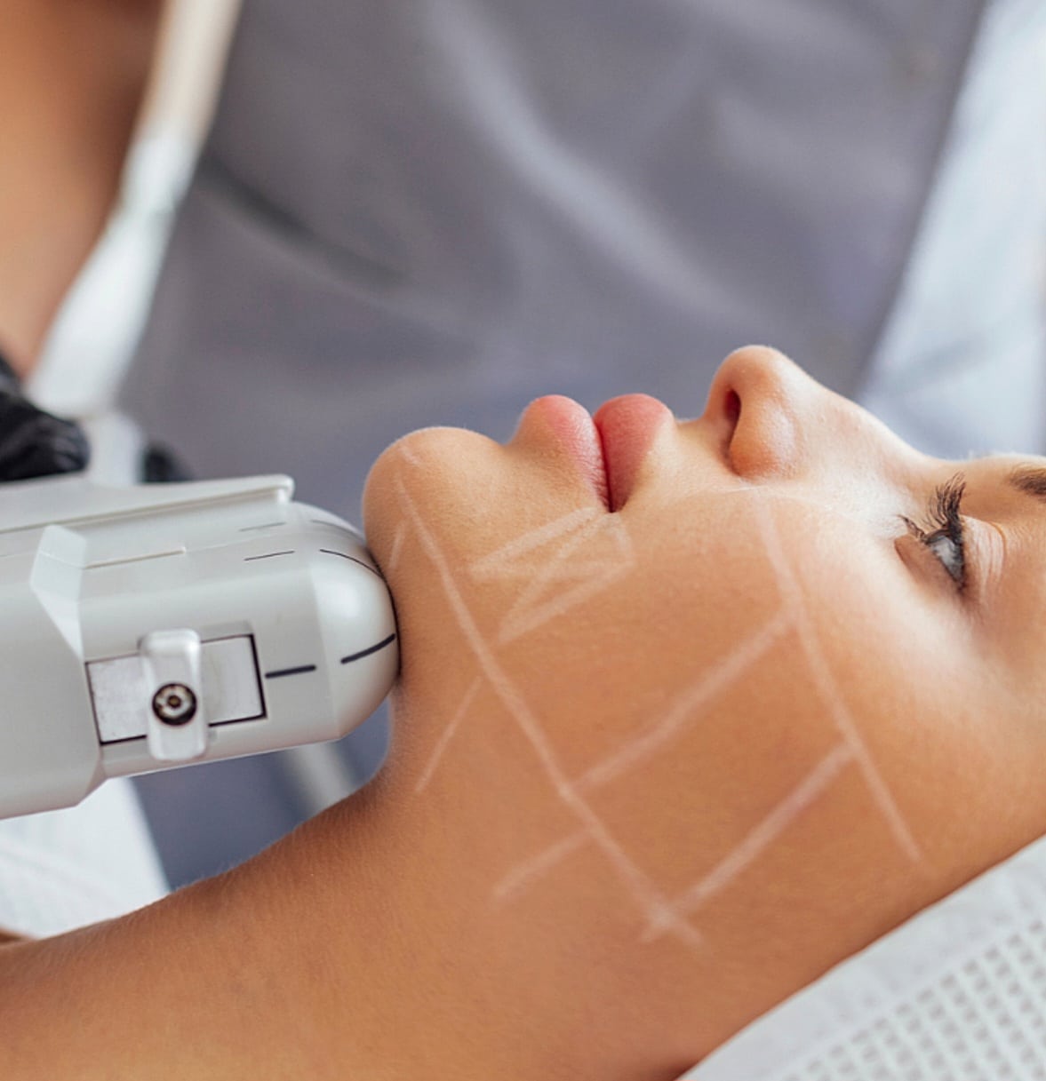 A woman receives a facial treatment with a handheld device on her chin, with white treatment markings on her cheek.
