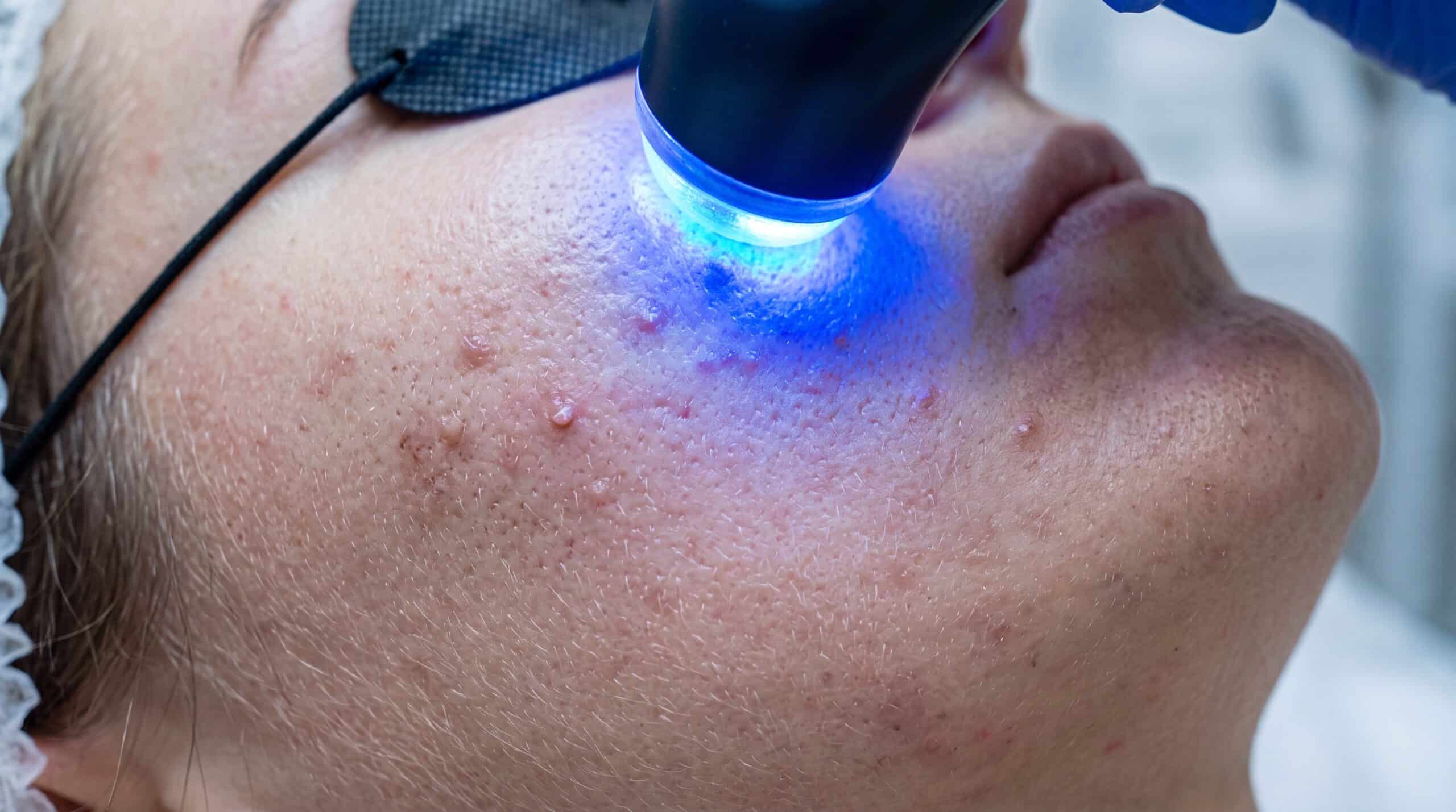 A close-up of a person's cheek being treated with a handheld blue-light device, with a protective eye shield resting near the temple.