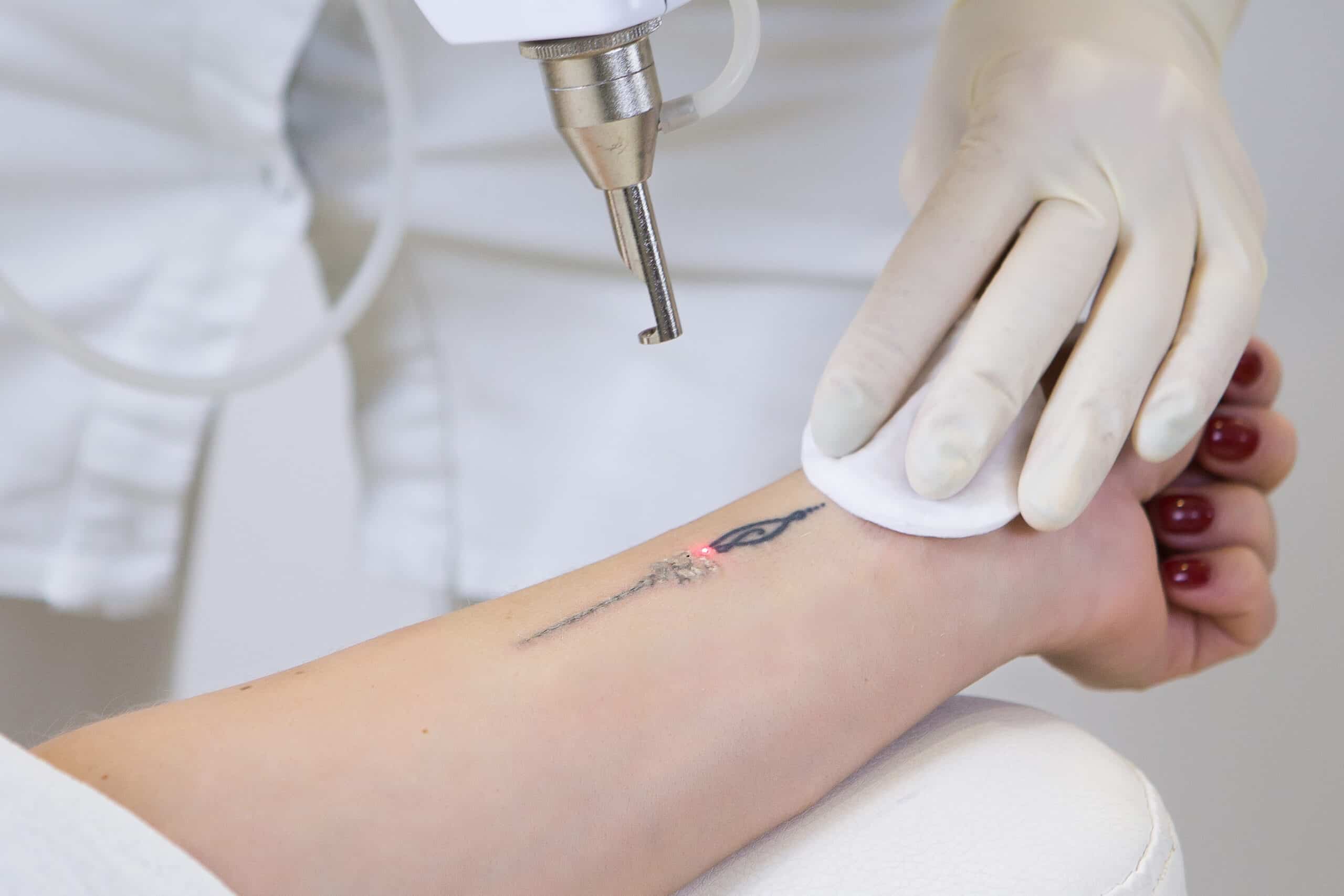 A gloved practitioner cleans a person’s forearm tattoo with a medical laser device, with a white cloth held against the skin.