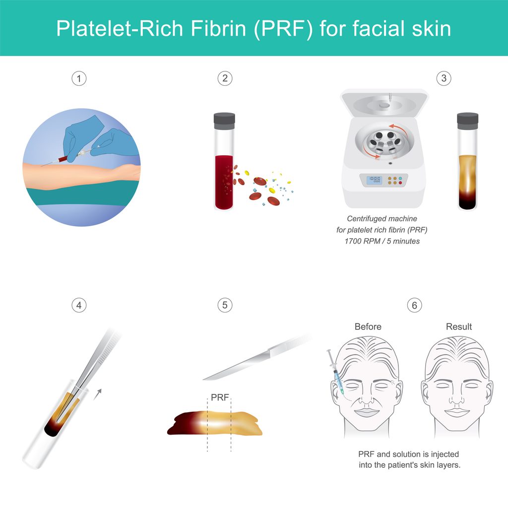 Vampire Facials: What to Know and How to Vet Your Med Spa - Elevate Med Spa A PRF facial skin treatment infographic shows six steps, including blood collected in a tube, a centrifuge, and before-and-after face sketches on a white background.